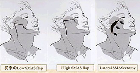 SMAS（表在性筋膜）への操作の違い